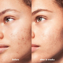 e.l.f SKIN Blemish Breakthrough Triple-Acid Resurfacing Serum
