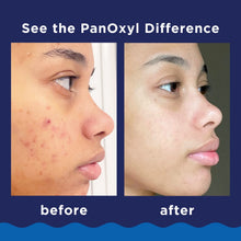 PanOxyl-Foaming-Acne-Wash-10-Ben4 - Brands For Less USA