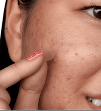 Peace Out Salicylic Acid Acne Day Dots, 60-pack